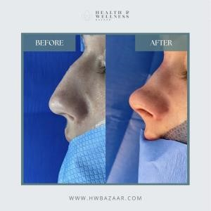 what is a closed rhinoplasty