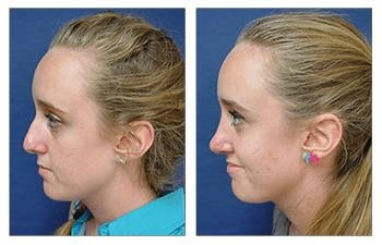 thick skin rhinoplasty expert