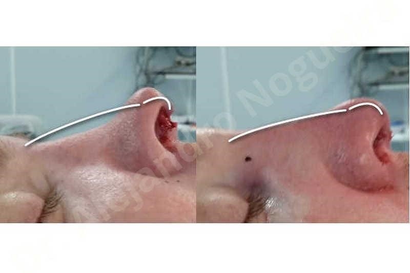 thick skin rhinoplasty expert