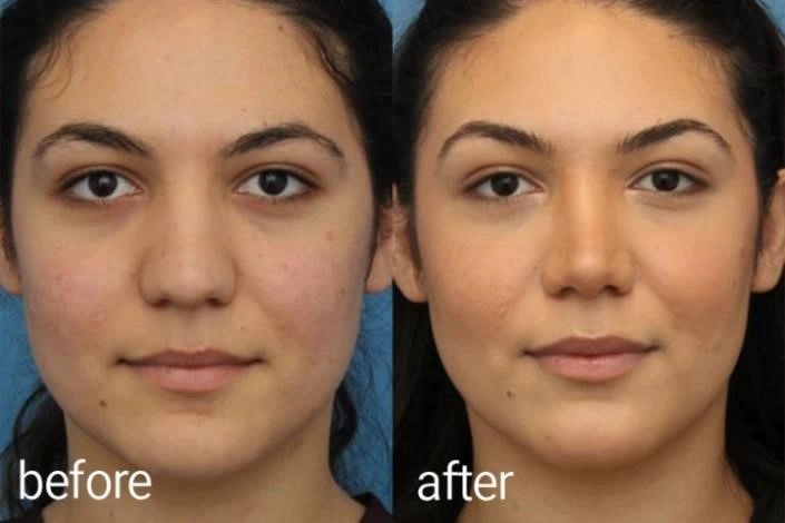 top rhinoplasty surgeons